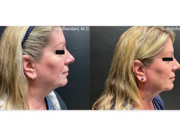 reNUplasty_vaserlipo_renuvion_before_and_after-1