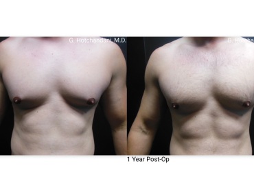 reNUplasty_vaserlipo_renuvion_before_and_after-10