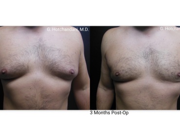 reNUplasty_vaserlipo_renuvion_before_and_after-11