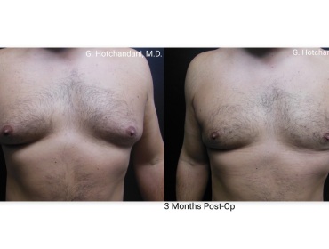 reNUplasty_vaserlipo_renuvion_before_and_after-11