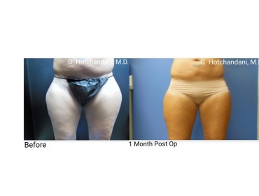 reNUplasty_vaserlipo_renuvion_before_and_after-12