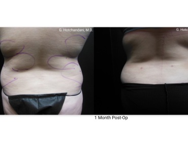 reNUplasty_vaserlipo_renuvion_before_and_after-13