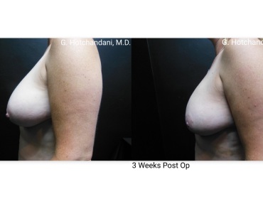 reNUplasty_vaserlipo_renuvion_before_and_after-14