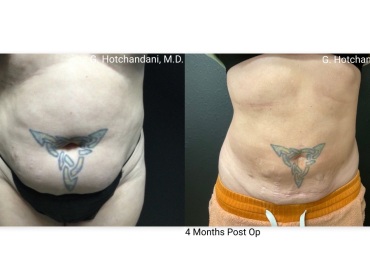 reNUplasty_vaserlipo_renuvion_before_and_after-15