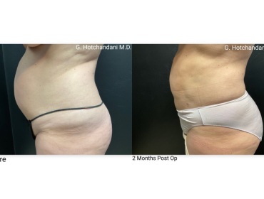 reNUplasty_vaserlipo_renuvion_before_and_after-16