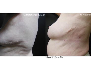 reNUplasty_vaserlipo_renuvion_before_and_after-17