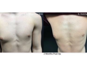 reNUplasty_vaserlipo_renuvion_before_and_after-18