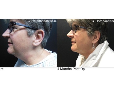 reNUplasty_vaserlipo_renuvion_before_and_after-19