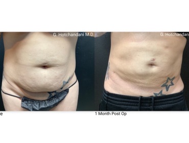 reNUplasty_vaserlipo_renuvion_before_and_after-2