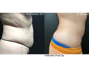 reNUplasty_vaserlipo_renuvion_before_and_after-21