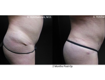 reNUplasty_vaserlipo_renuvion_before_and_after-22