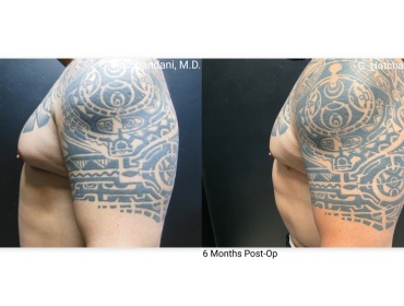 reNUplasty_vaserlipo_renuvion_before_and_after-23
