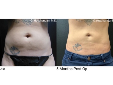 reNUplasty_vaserlipo_renuvion_before_and_after-24