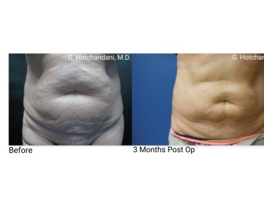 reNUplasty_vaserlipo_renuvion_before_and_after-25