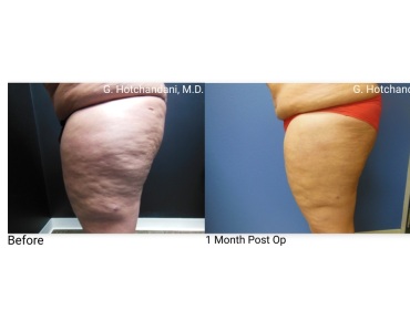 reNUplasty_vaserlipo_renuvion_before_and_after-26
