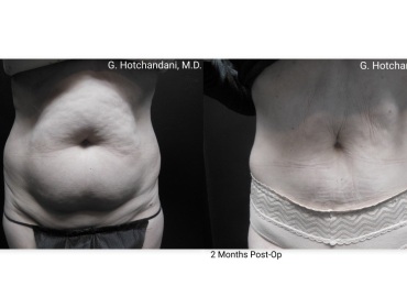 reNUplasty_vaserlipo_renuvion_before_and_after-27