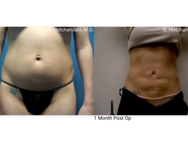 reNUplasty_vaserlipo_renuvion_before_and_after-28