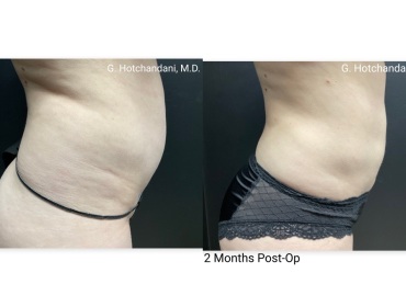 reNUplasty_vaserlipo_renuvion_before_and_after-29