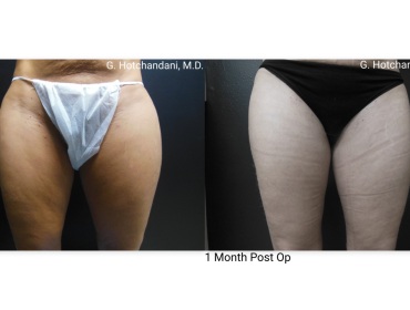 reNUplasty_vaserlipo_renuvion_before_and_after-3