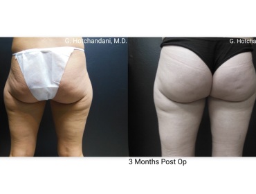 reNUplasty_vaserlipo_renuvion_before_and_after-30