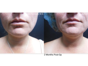 reNUplasty_vaserlipo_renuvion_before_and_after-31