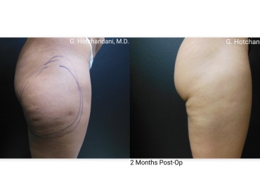 reNUplasty_vaserlipo_renuvion_before_and_after-34