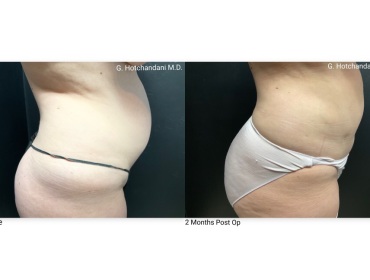 reNUplasty_vaserlipo_renuvion_before_and_after-36