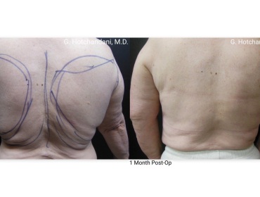reNUplasty_vaserlipo_renuvion_before_and_after-38