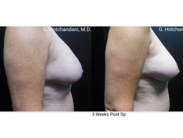 reNUplasty_vaserlipo_renuvion_before_and_after-39