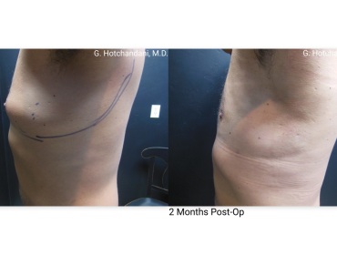 reNUplasty_vaserlipo_renuvion_before_and_after-4