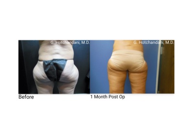 reNUplasty_vaserlipo_renuvion_before_and_after-40