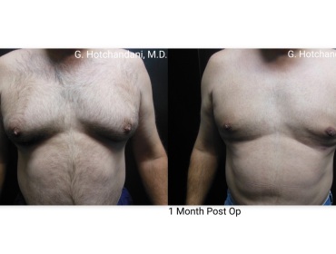 reNUplasty_vaserlipo_renuvion_before_and_after-41