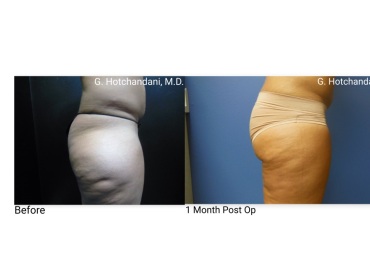 reNUplasty_vaserlipo_renuvion_before_and_after-42