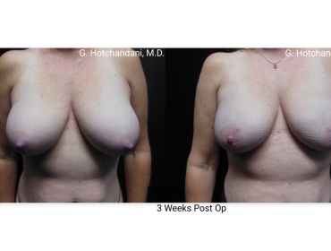 reNUplasty_vaserlipo_renuvion_before_and_after-43