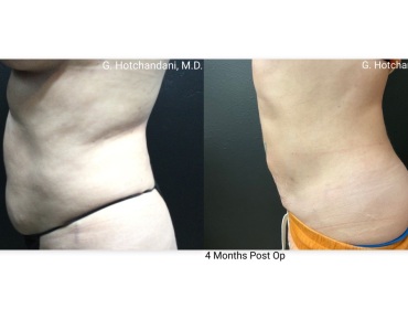 reNUplasty_vaserlipo_renuvion_before_and_after-44