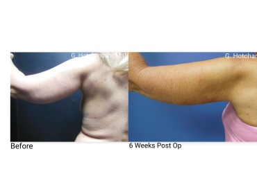 reNUplasty_vaserlipo_renuvion_before_and_after-45