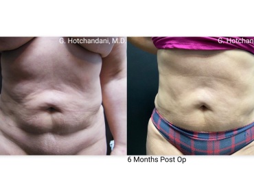 reNUplasty_vaserlipo_renuvion_before_and_after-46