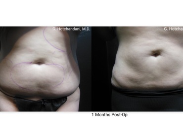 reNUplasty_vaserlipo_renuvion_before_and_after-47