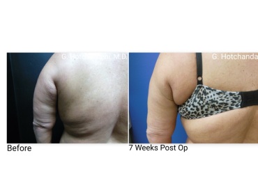reNUplasty_vaserlipo_renuvion_before_and_after-48