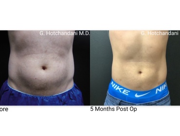 reNUplasty_vaserlipo_renuvion_before_and_after-49