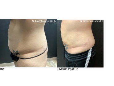reNUplasty_vaserlipo_renuvion_before_and_after-5