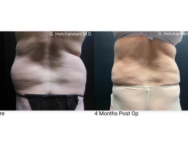reNUplasty_vaserlipo_renuvion_before_and_after-50