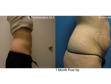 reNUplasty_vaserlipo_renuvion_before_and_after-51