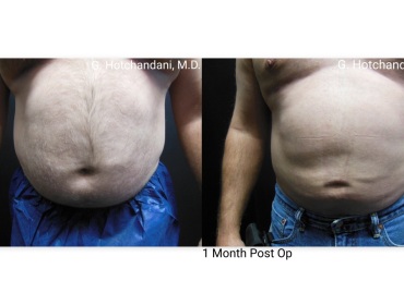 reNUplasty_vaserlipo_renuvion_before_and_after-52
