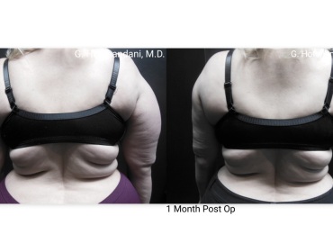 reNUplasty_vaserlipo_renuvion_before_and_after-53