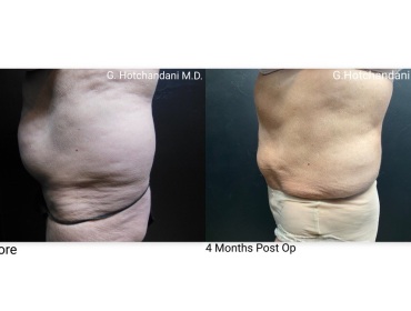 reNUplasty_vaserlipo_renuvion_before_and_after-54
