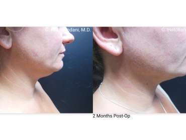 reNUplasty_vaserlipo_renuvion_before_and_after-55