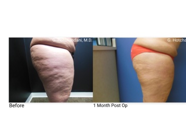 reNUplasty_vaserlipo_renuvion_before_and_after-56
