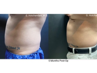 reNUplasty_vaserlipo_renuvion_before_and_after-57