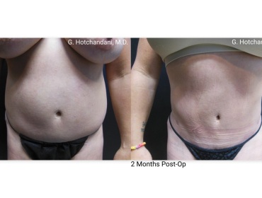 reNUplasty_vaserlipo_renuvion_before_and_after-58